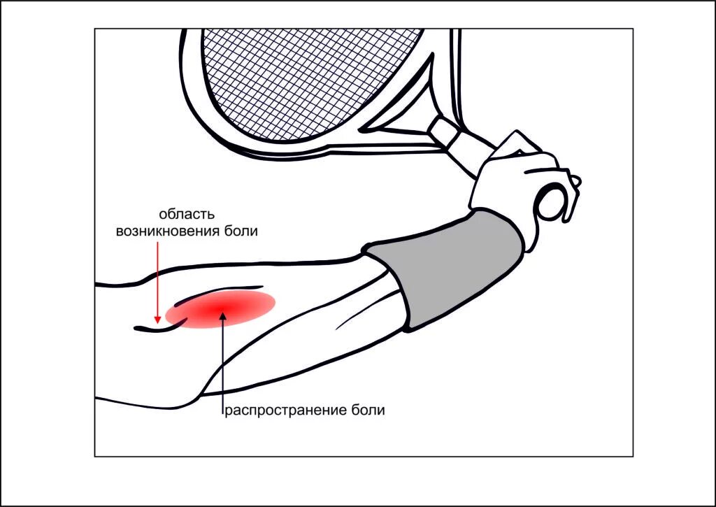 Почему болят локтевые сгибы. Латеральный эпикондилит локтевого. Эпикондилит локтевого упражнения. Латеральный локоть теннисиста. Латеральный эпикондилит локтевого сустава.