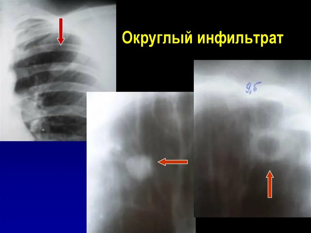 Округлый инфильтрат