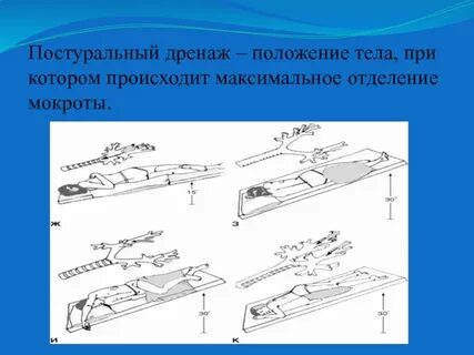 Постуральный дренаж алгоритм