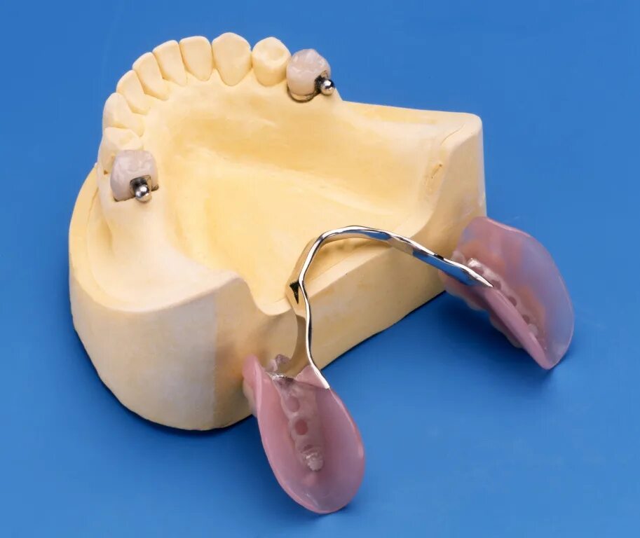 Бюгельный протез замковый (2 замка Bredent). Бюгельный протез на замках Бредент. Бюгельный съемный протез на замках Bredent. Замки Бредент для бюгельного протеза. Бюгельный протез крепление