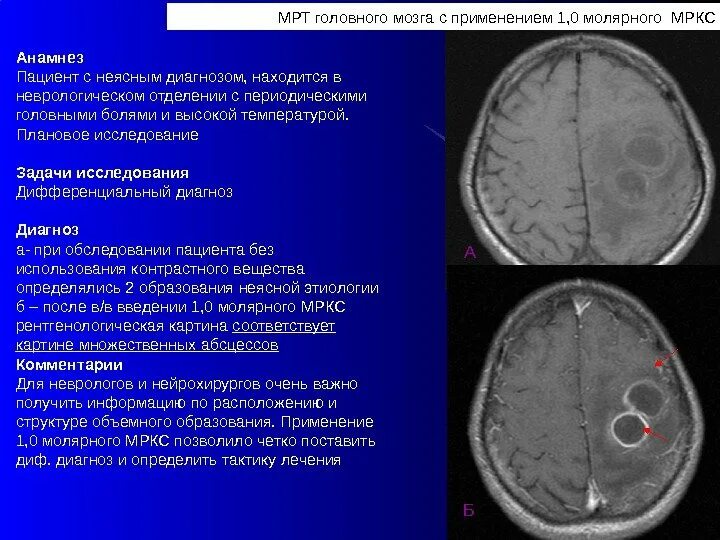 Мрт какие диагнозы. Образование головного мозга кт. Кт головного мозга диагноз. Кт мрт опухоли головного мозга. Опухоль головного мозга на мрт с контрастом.