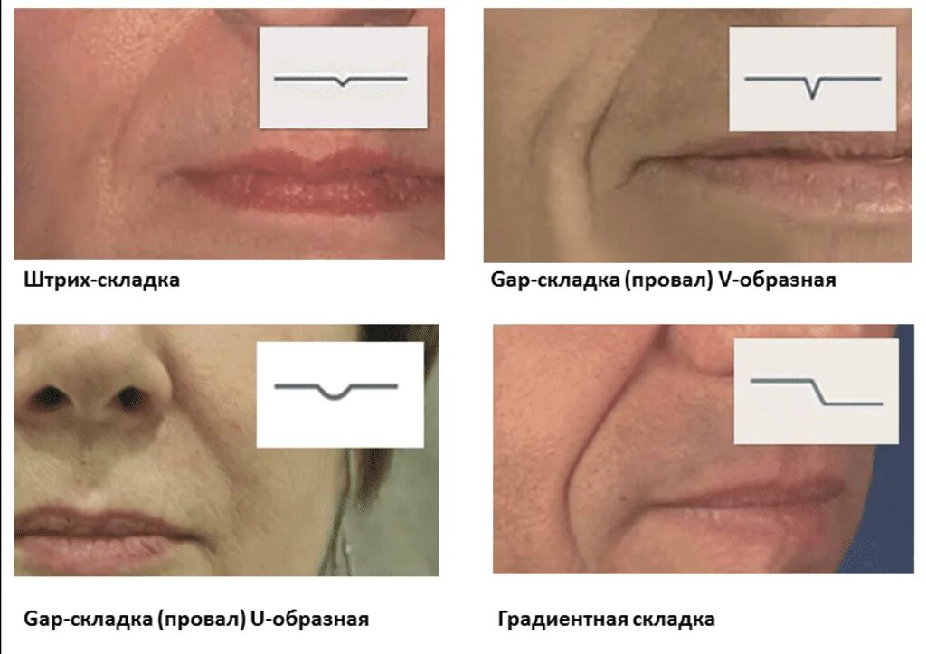 Почему образовываются складки. Классификация носогубных складок. Штрих-складка носогубка. Тип носогубной складки. Штрих складка носогубная.