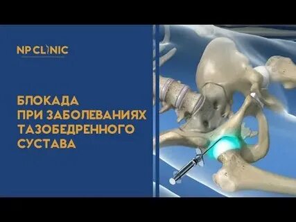 Укол блокада тазобедренного сустава