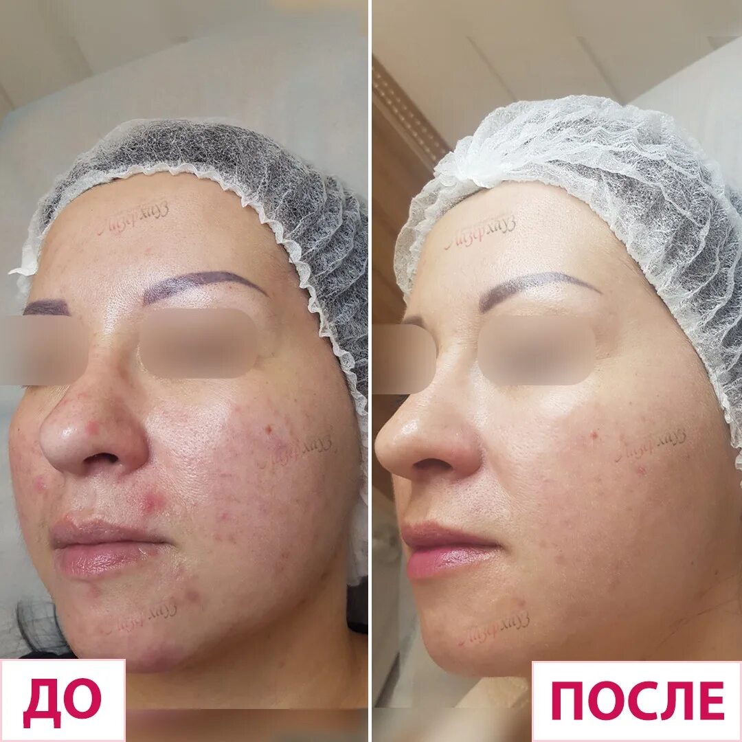 Лазерная шлифовка кожи цена skinlift ru. Лазерная шлифовка лица до и после. Лазерная шлифовка лиыо. После лазерной шлифовки. Лазерное шлифование лица.