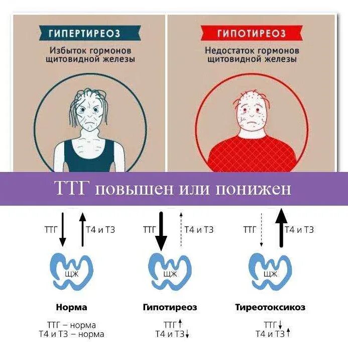 Гипертиреоз симптомы и лечение