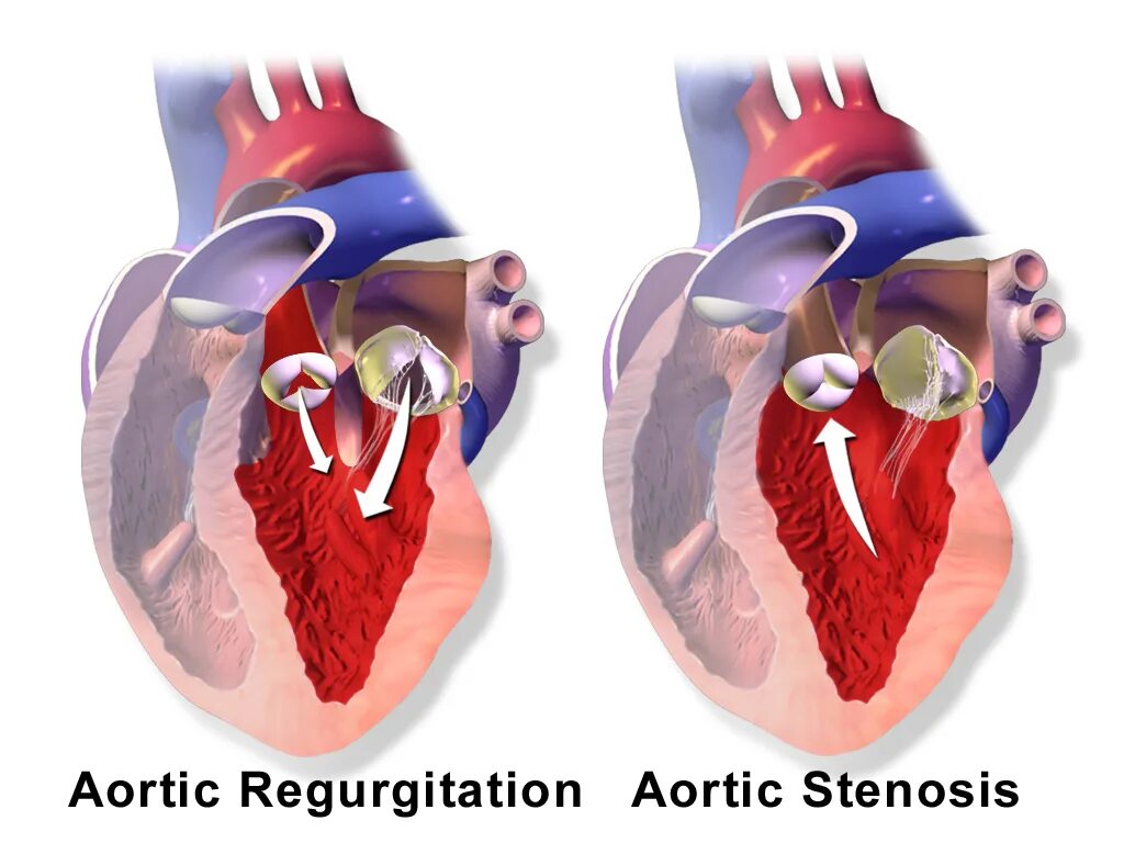 Сердечный стеноз. Порок сердца стеноз аортального клапана. Стеноз аортального клапана клапан. Стеноз и недостаточность аортального клапана. Стеноз двустворчатого аортального клапана.