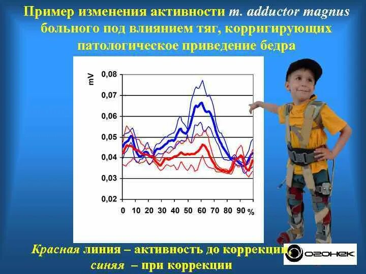 Сколько людей с дцп. Средняя Продолжительность жизни с ДЦП. Дети с ДЦП Продолжительность жизни. ДЦП тяжелая форма Продолжительность жизни. Продолжительность жизни с ДЦП статистика.