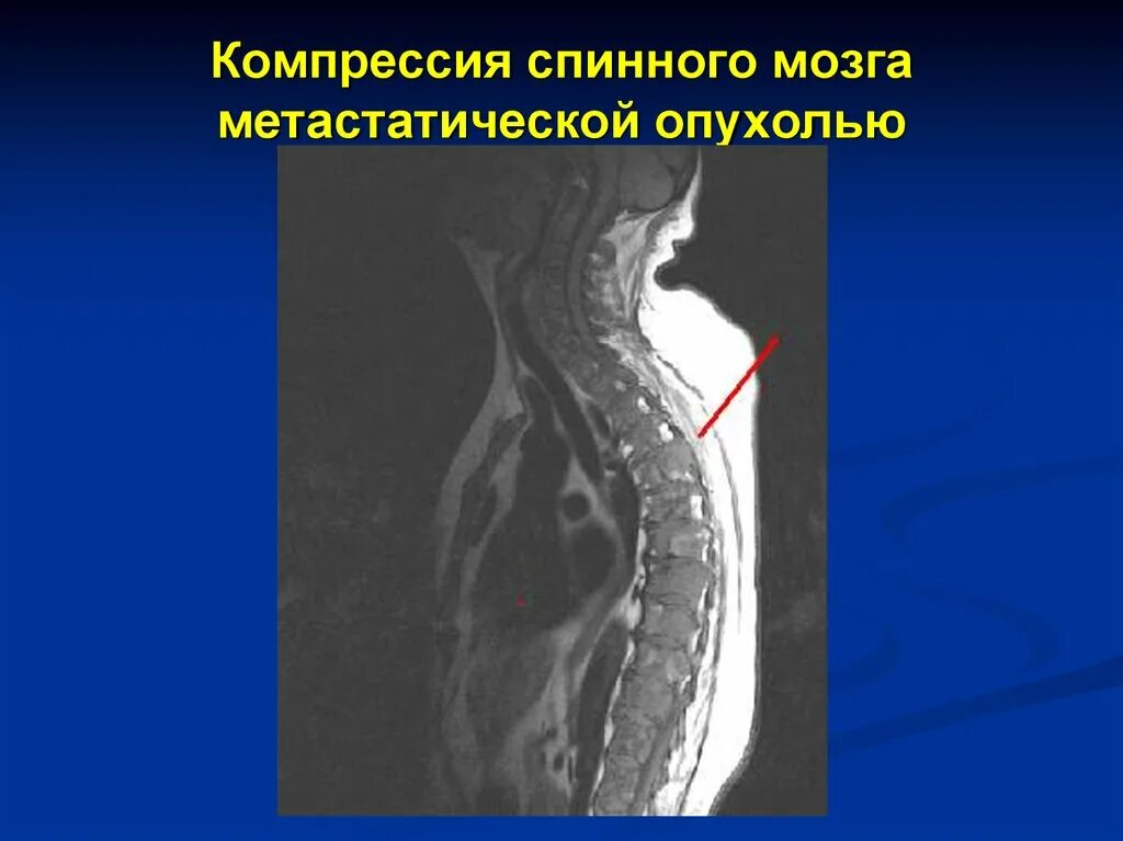 Сдавление спинного. Компрессия спинного мозга. Объемное образование спинного мозга. Сдавление спинного мозга.