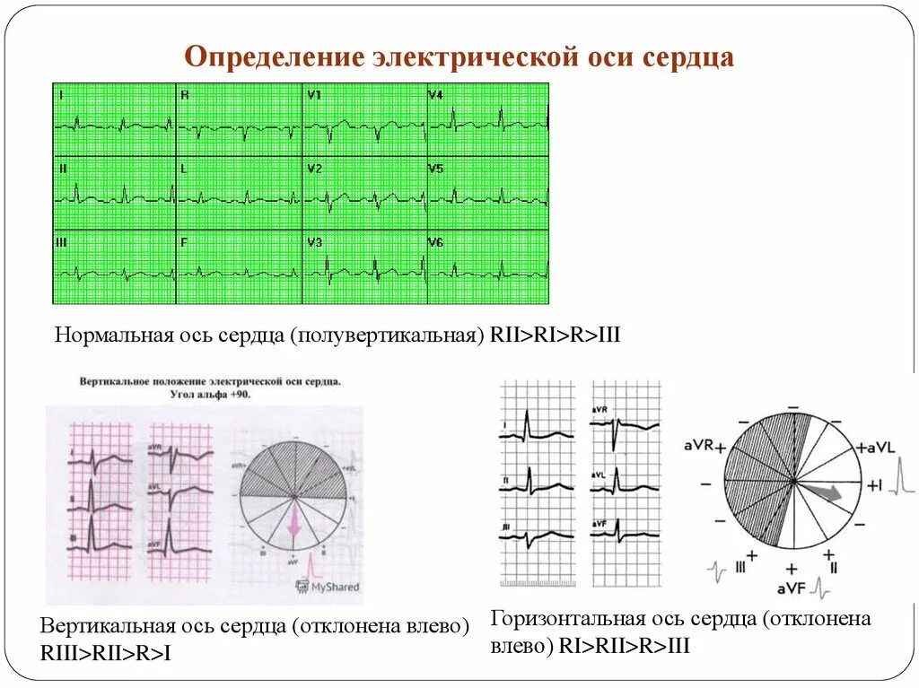 Вертикальная позиция сердца. Вертикальное положение ЭОС на ЭКГ. Как определить положение электрической оси сердца на ЭКГ. Вертикальное положение электрической оси сердца на ЭКГ. Определение положения ЭОС на ЭКГ.