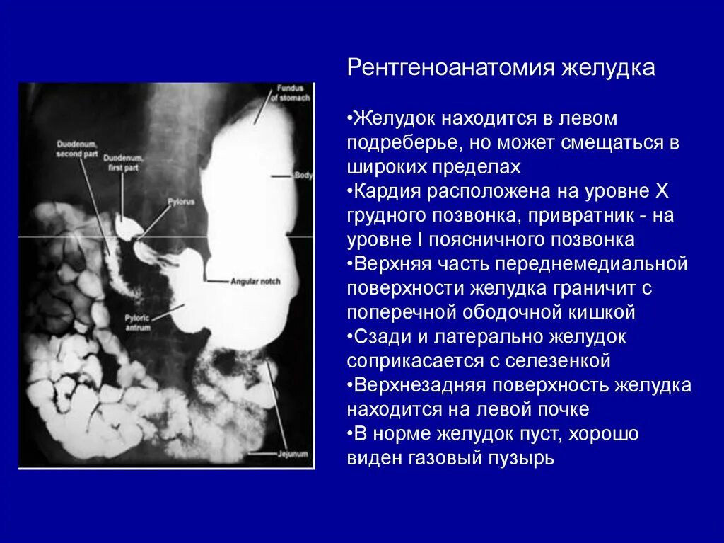 Рентгенография пищевода желудка и ДПК. Опухоль 12 перстной кишки на рентгене. Желудок тонкий кишечник рентгеноанатомия. Рентгеноскопии желудка и 12-перстной. Скопия пищевода желудка