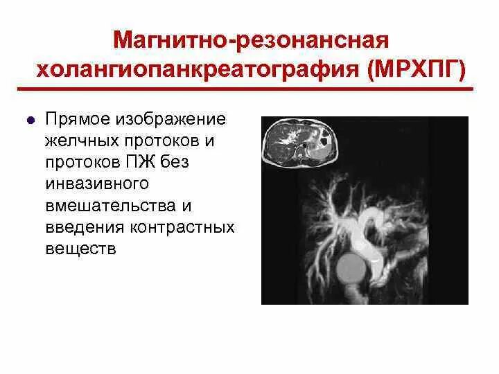 МРХПГ хронический панкреатит. МРХПГ поджелудочной железы. Холангиопанкреатография МРХПГ. Магнитно резонансная холангиопанкреатография МРХПГ.