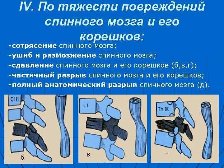 Почему так опасно повреждение спинного мозга. Сотрясение спинного мозга. травмы корешков спинного мозга. полный разрыв спинного мозга. сотрясение и ушиб спинного мозга.