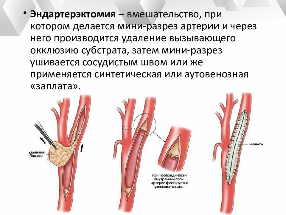 Эндартерэктомия это