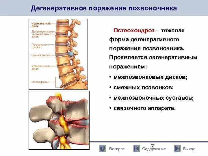 Выраженное дегенеративное изменение позвоночника. Дегенеративно-дистрофические заболевания позвоночника (ддзп). межпозвонковый остеохондроз (поражение до 3 межпозвонковых дисков). дистрофические изменения пояснично-крестцового отдела позвоночника. дегенеративно-дистрофические поражение позвоночника диагноз.