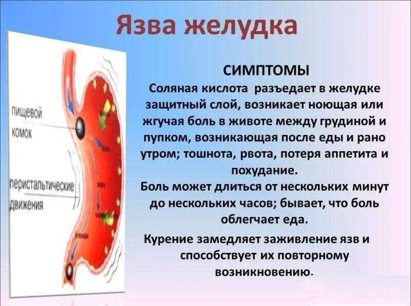 Болит желудок что попить. Язвенная болезнь желудка симптомы. Признаки язвенной болезни желудка. Проявление язвы желудка.