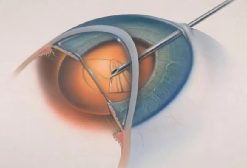 Искусственный хрусталик глаза. Дислокация хрусталика после операции. Аппарат факоэмульсификация. Замена хрусталика что нельзя делать после операции