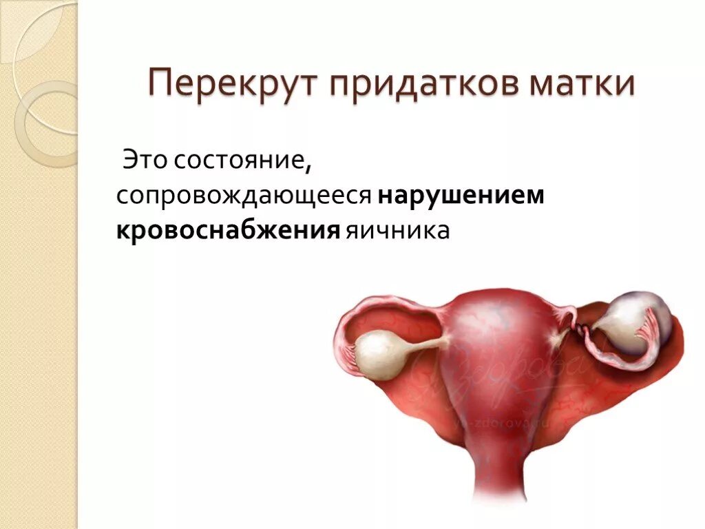 Перекрут придатков матки. Перекрут придатков матки