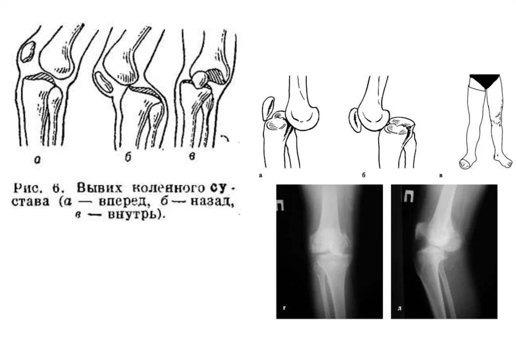 Растяжение связок сустава мкб. Вывих коленного сустава мкб-10. Вывих коленного сустава мкб. Вывих коленного сустава вперед рентген. Разрыв связок коленного сустава мкб 10.