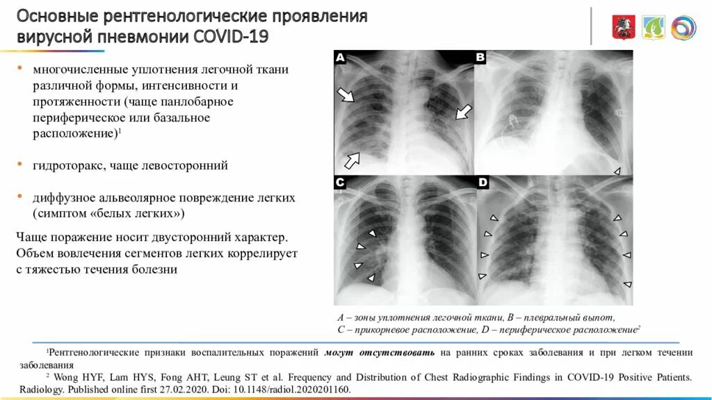 Вирусная пневмония ковид кт. Вирусная пневмония рентген. Рентгенологические симптомы пневмонии. Поражение легких 3