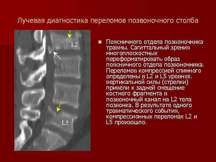 Лучевая диагностика повреждений позвоночника. Рентгенодиагностика позвоночника. Перелом позвоночника диагноз. Размер позвоночного канала в поясничном отделе норма.