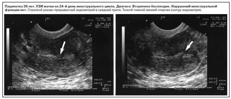 Толщина эндометрии для зачатия. УЗИ нормального эндометрия. Эндометрия матки УЗИ гиперплазия эндометрия. Эндометрий на УЗИ норма.