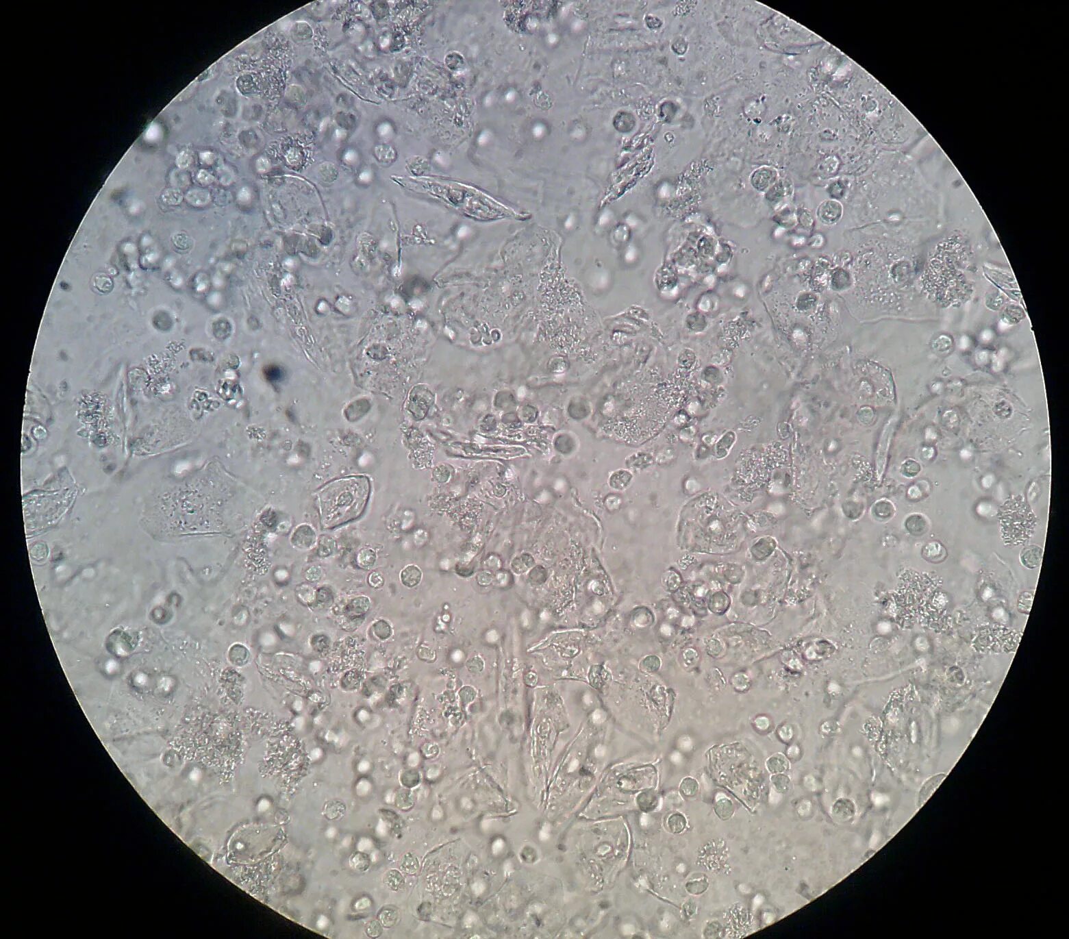 File:UrinaryInfection.jpg - Wikipedia