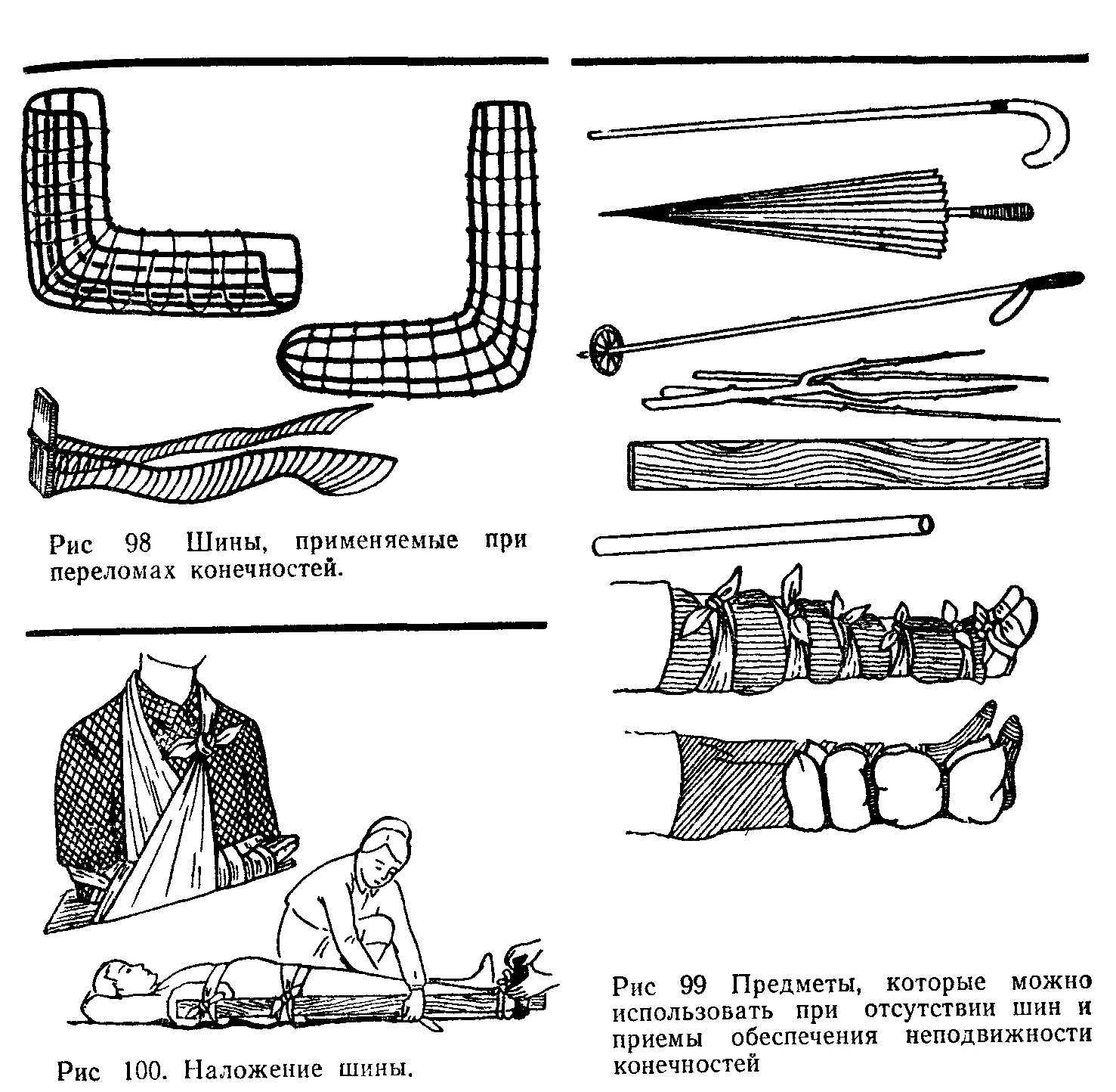 Техника наложения шин при переломах