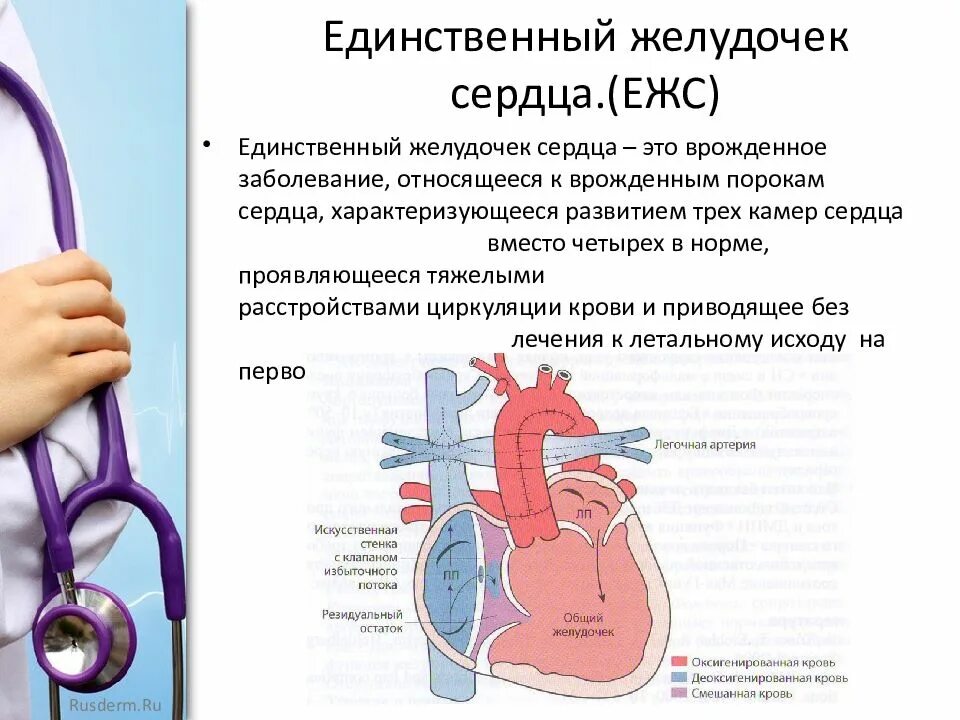 Единственный желудочек сердца. Двуприточный единственный желудочек сердца. Единственный левый желудочек сердца. Единственный правый желудочек сердца.