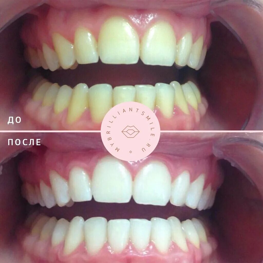 Brilliant отбеливание 14. Brilliant smile отбеливание. Brilliant smile отбеливание. отбеливание зубов дома капы. карандаш для отбеливания зубов до и после.