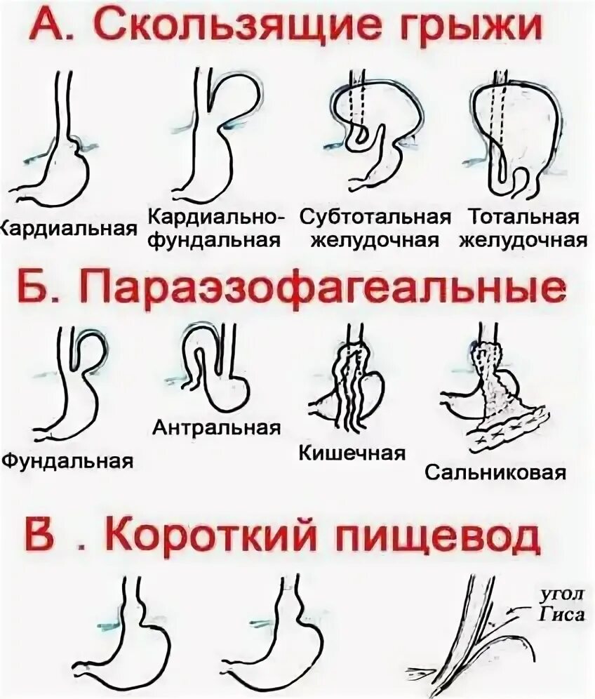 Грыжа пищеводного отверстия диафрагмы упражнения. Симптомы блуждающей грыжи пищевода. Диета при грыже пищеводного отверстия диафрагмы меню и рецепты. Аксиальная хиатальная грыжа.