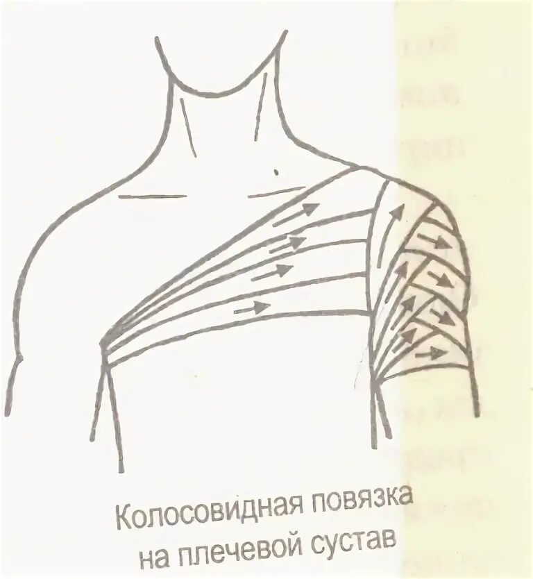 Техника наложения повязки на плечо. Колосовидная бинтовая повязка. Техника наложения колосовидной повязки на плечо. Десмургия колосовидная повязка на плечевой сустав. Колосовидная повязка показания.
