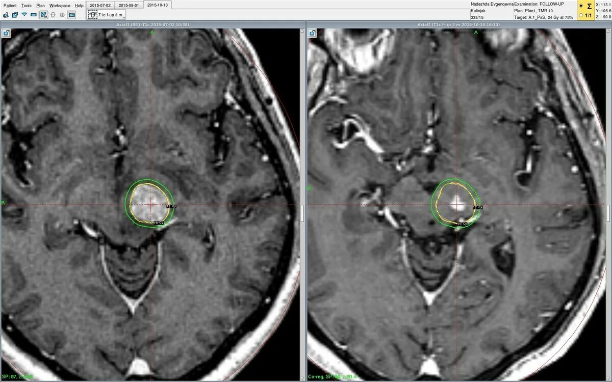 Метастазы в головном мозге. Метастазы РМЖ В головной мозг на кт. Прогноз жизни при метастазах
