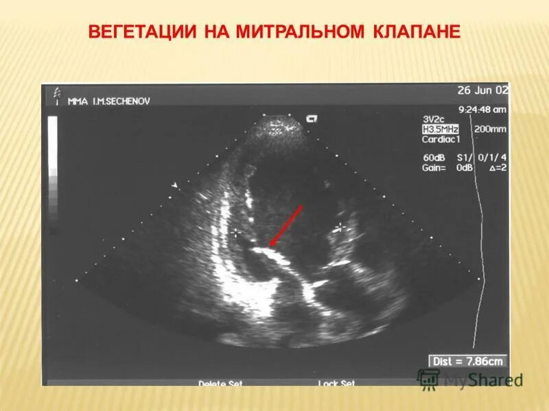 Вегетации на клапанах. Вегетации на митральном клапане УЗИ. Вегетации на митральном клапане. Вегетации на створках митрального клапана. Вегетации на аортальном клапане.