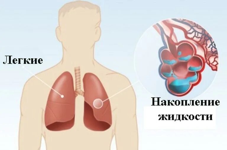 Отек легких жидкость. Жидкость в альвеолах легких. Накопление жидкости в легких.