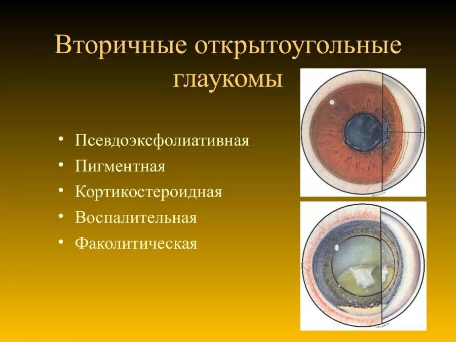 Глаукома глаза причины. Неопластическая глаукома. Вторичная факолитическая глаукома. Вторичная увеальная глаукома. Неоваскулярная закрытоугольная глаукома.