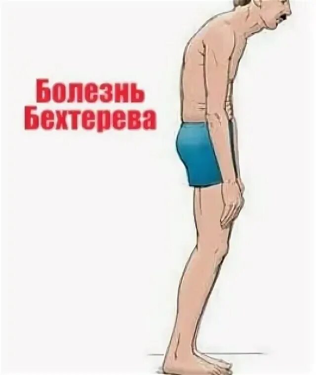 Бехтерева инвалидность. Ахиллобурсит болезнь бехтерева. болезнь бахтьярова. болезнь бехтерева симптомы. болезнь спины бехтерева.
