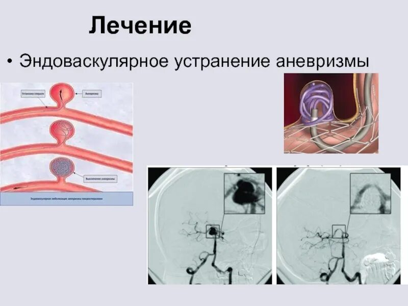 Эндоваскулярная эмболизация сосудов головного мозга. Эндоваскулярная хирургия аневризмы головного мозга. Эндоваскулярная операция аневризмы сосудов головного мозга. Клипирование аневризмы сосудов. Аневризма мозга простыми словами