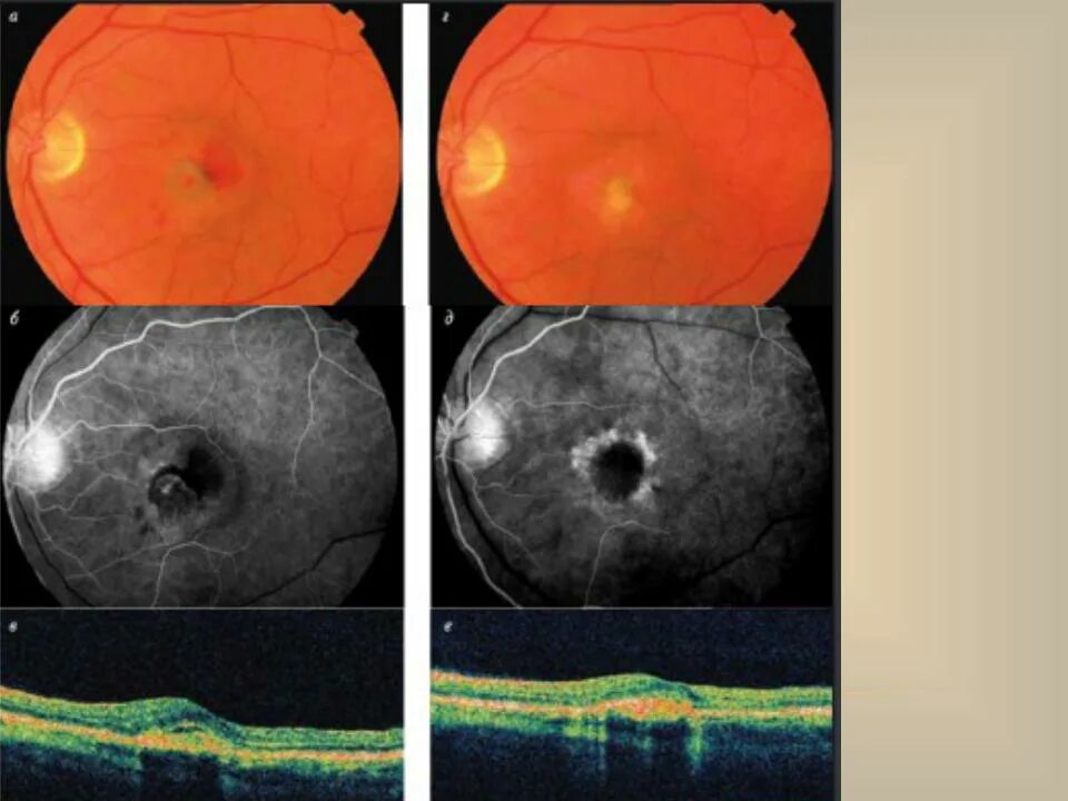 Периферические ретинальные дегенерации. Возрастная макулярная дегенерация сетчатки. Макулярная дегенерация сетчатки симптомы. Макулодистрофия на окт сетчатки. Макулодистрофия сетчатки сухая форма.