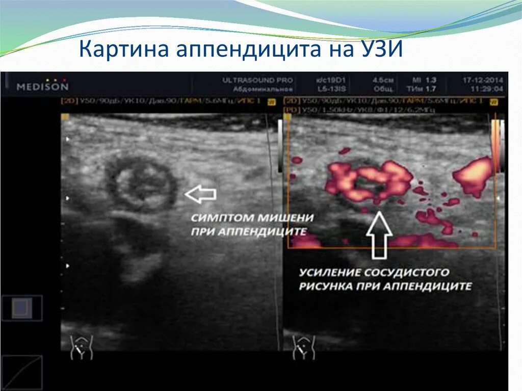 Аппендикулярный отросток на УЗИ. УЗИ картина острого аппендицита. УЗИ картина острого аппендицита у детей. УЗИ острого аппендицита презентация.