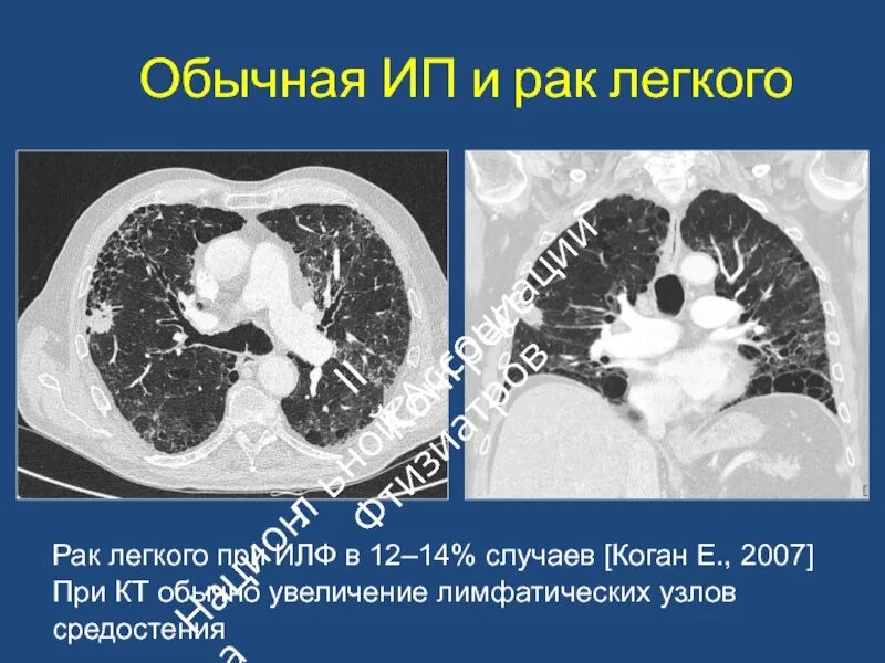 Фиброз кт. Идиопатический легочный фиброз кт. идиопатический легочный фиброз (илф). кт при идиопатическом легочном фиброзе.