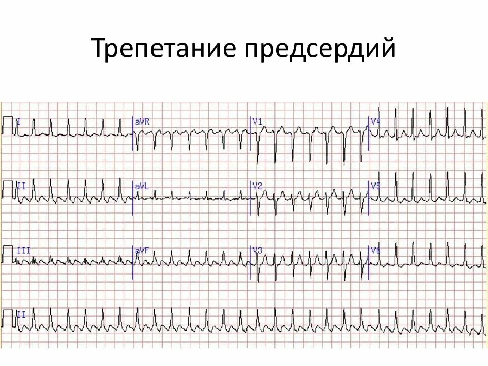 Пароксизмальная тахикардия мерцательная аритмия. Трепетание предсердий 2 к 1 на экг. пароксизмальное трепетание предсердий экг. правильная форма трепетания предсердий на экг. фибрилляция и трепетание предсердий пароксизмальная форма на экг.