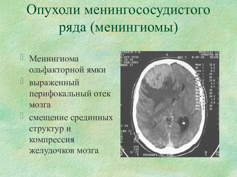 Опухоли желудочков. Менингиомы черепной ямки. Менингиома апластическая. Опухоль головного мозга ольфакторной ямки. Опухоли менингососудистого ряда.