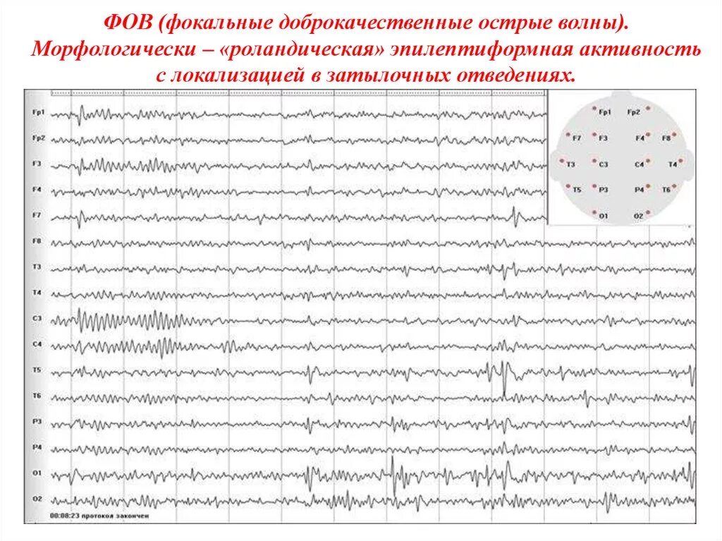 Диффузные эпилептиформные. Эпилептиформные феномены на ЭЭГ что это. Эпилептиформные паттерны на ЭЭГ. Роландическая эпилепсия ЭЭГ. ЭЭГ эпилепсия пик-волна.