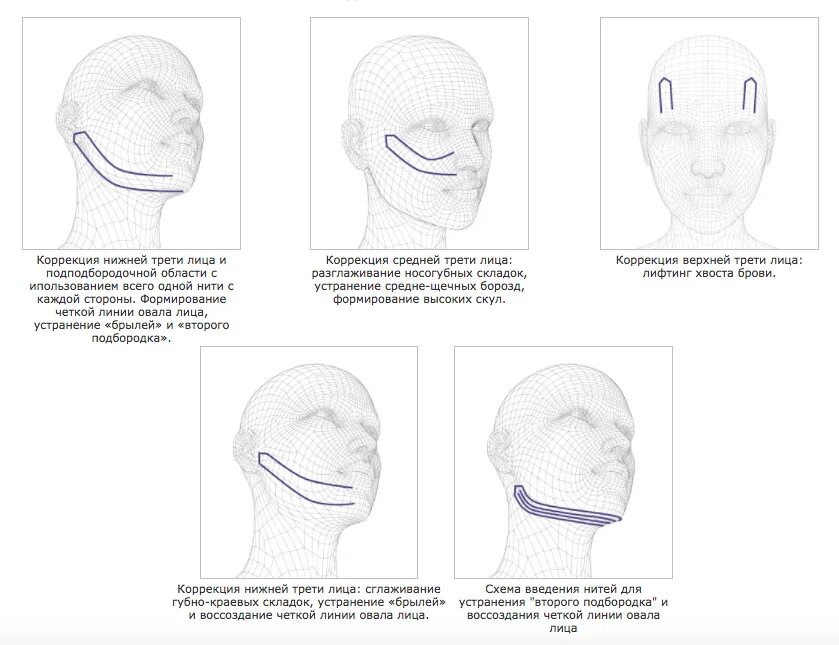 Нити Aptos visage схема. Схема постановки нитей Коги. Нити дуалы схемы введения. Схема введения нитей для овала лица. Схема подтяжки лица