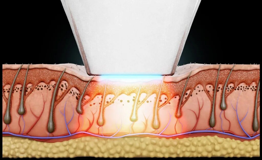 Воздействие диодного лазера на волосы. Воздействие диодного лазера на кожу. Воздействие лазера на волосяной фолликул.
