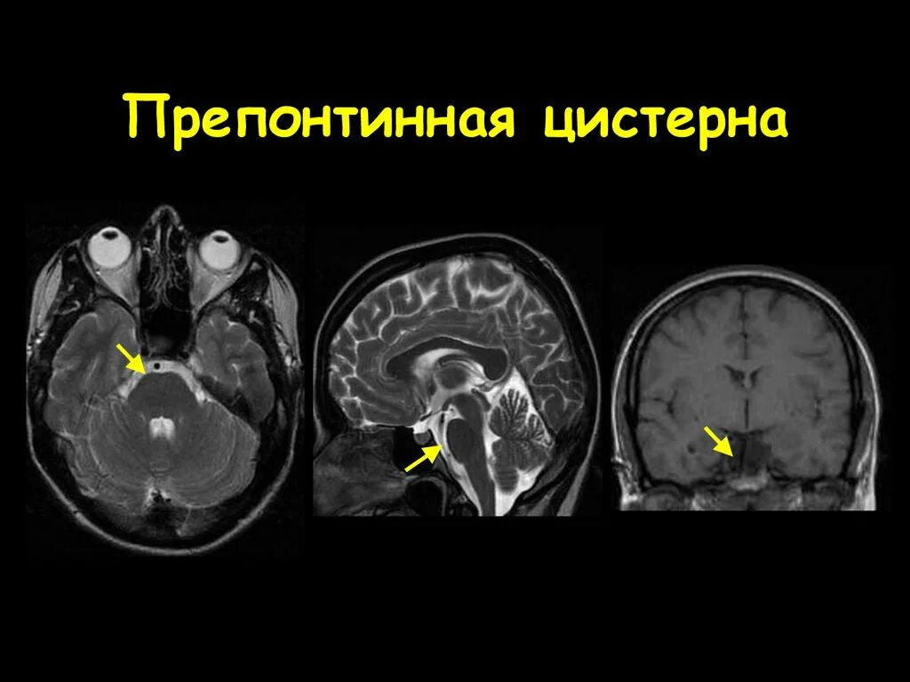 Цистерны мозга расширены. Базальные цистерны головного мозга кт анатомия. Цистерны головного мозга на мрт анатомия. Киста цистерны четверохолмия кт. Киста цистерны четверохолмия мрт.