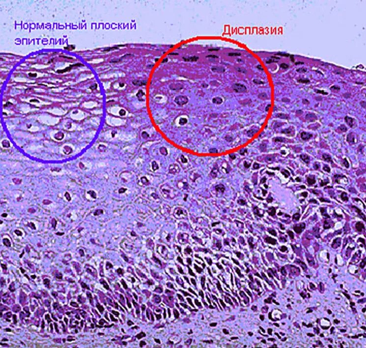 Плоскоклеточное интраэпителиальное поражение низкой. Многослойный плоский эпителий шейки матки гистология. Дисплазия шейки матки гистология. Лейкоплакия шейки матки гистология. Цитология дисплазия эпителия.