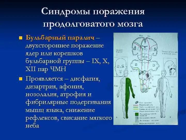 Поражение ствола головного. Синдром поражения ствола головного мозга альтернирующие синдромы. Синдромы при поражении ствола головного мозга. Бульбарная синдром продолговатый мозг. Синдромы поражения продолговатого мозга.