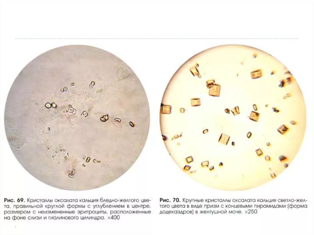 Кристаллы кальция в моче у мужчин. Оксалаты кальция микроскопия. Оксалаты кальция в моче микроскопия. Микроскопия осадка мочи Кристаллы оксалата кальция. Соли оксалата кальция в моче микроскопия.