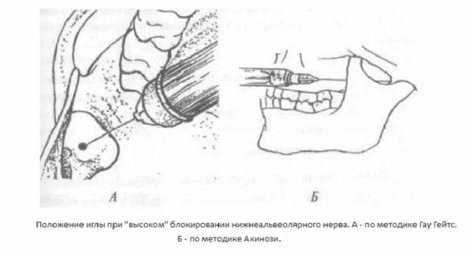 Проводниковая анестезия нижней челюсти мандибулярная. Мандибулярная анестезия ориентиры. Мандибулярная анестезия в стоматологии. Методика Акинози анестезия.